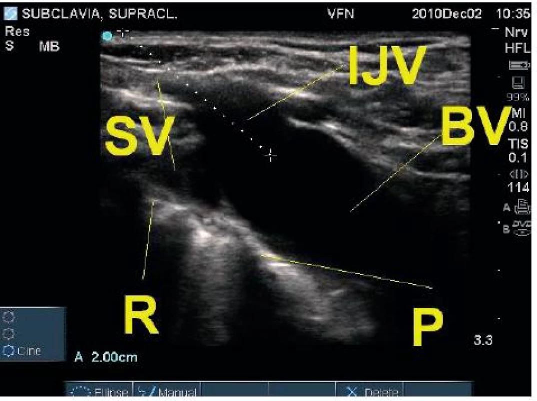 Zobrazení vena jugularis interna, vena subclavia a vena brachiocephalica ze supraklavikulárního okna