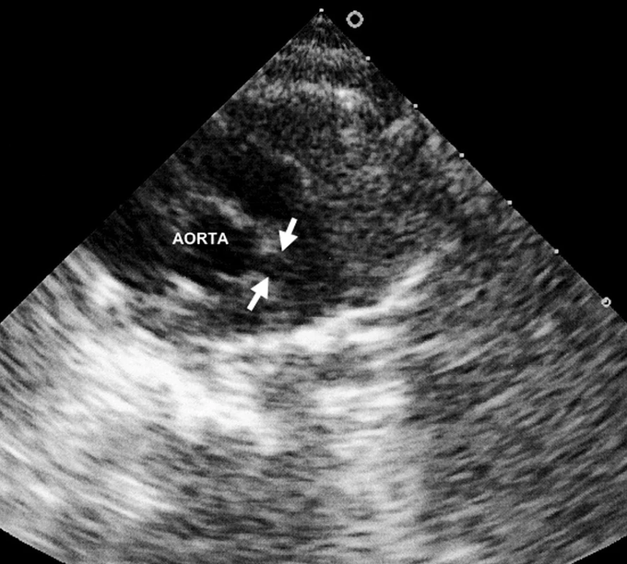 Fuziformní aneuryzma hlavního kmene levé koronární arterie.
Fig. 1. Fusiform aneurysms of the main stem of the left coronary artery.