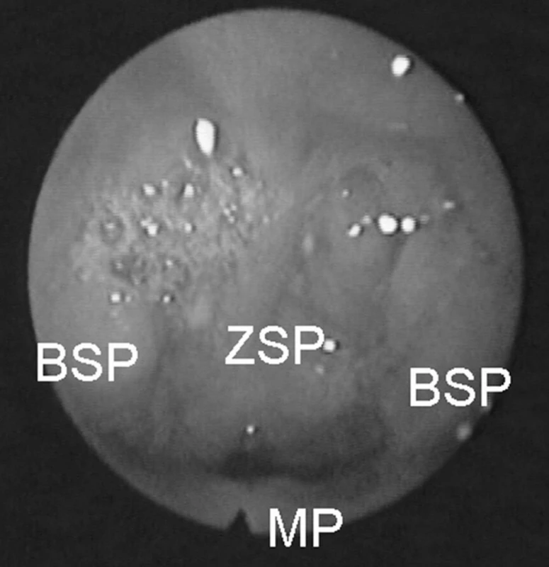 Nasoendoskopický obraz velofaryngeálního uzávěru. BSP – boční stěna faryngu, ZSP – zadní stěna faryngu, MP – měkké patro.