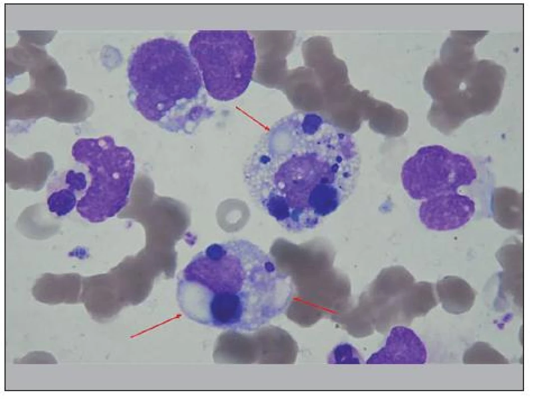 Centrálně a uprostřed dole dvě buňky RMS, fagocytující zbytky buněk, buněčných jader a fragmenty erytrocytů. Nejde o fagocytující histiocyty. Dále v těchto buňkách vidíme, velké vakuoly, nápadná jsou zde hlavně „jezírka“, „lakes“ (viz šipky), vzniklá splynutím vakuol, velmi častá u buněk RMS, takže jsou diagnostickou pomůckou. Na snímku jsou ještě další buňky RMS a jejich holá jádra, vlevo segmentovaný neutrofil a na dolním okraji je viditelná ½ neutrofilního segmentu.