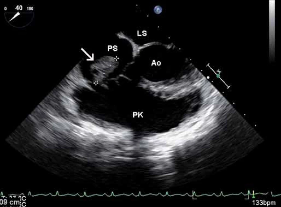 Snímek z jícnového echokardiografického vyšetření zobrazující vegetaci (bílá šipka) v pravé síni v systole nasedající na síňovou stranu trikuspidální chlopně – projekce na pravostranné srdeční oddíly.
PK – pravá komora, PS – pravá síň, LS – levá síň, Ao – aorta