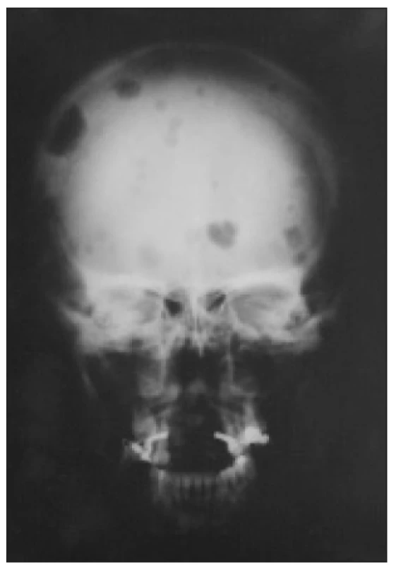 Osteolytická ložiska v lebce při terciární hyperparatyreóze. Podkladem jsou nádory z vícejaderných obrovských buněk, tzv. hnědé tumory.