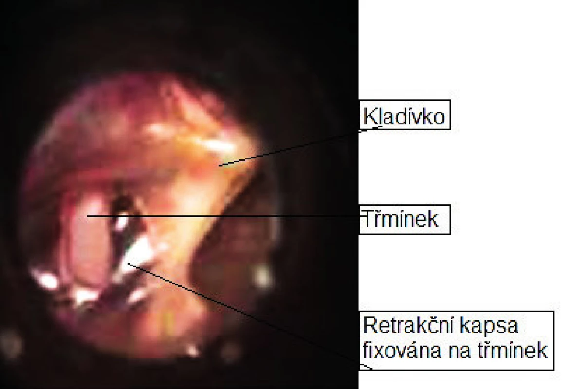 Obr. 5. Retrakční kapsa ušního bubínku.
Fig. 5. Retraction pocket of the tympanic membrane.