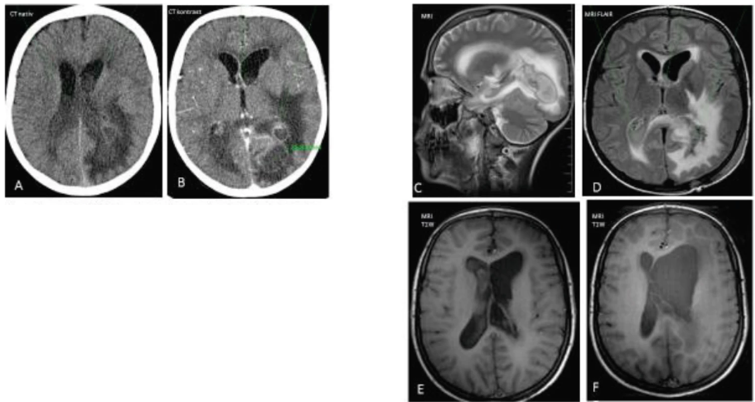 Vývoj CT a MRI nálezu u pacienta č. 3.
A–B. CT natív – patologický obsah v mozgových komorách, prevalenie abscesu do komôr, perifokálny edém, absces s priemerom 25,8 mm – temporo-occipitálne vľavo.
C. Rozšírenie ľavej bočnej komory so septami po ventrikulitíde.
D. Stav po opakovaných punkciách abscesu. Pretrváva patologický obsah v komorách, zmenšenie abscesovej dutiny.
Fig. 3. The changes of CT and MRI in a case 3.
A–B. CT native scan – a pathologic content within the ventricles of brain (pus), a perifocal edema, an abscess in diameter 25.8 mm in the left temporo-occipital area.
C. Dilatation of the left ventricle with the septs.
D. The lesion after repeated punctures of abscess. A pathological content (pus) persists.