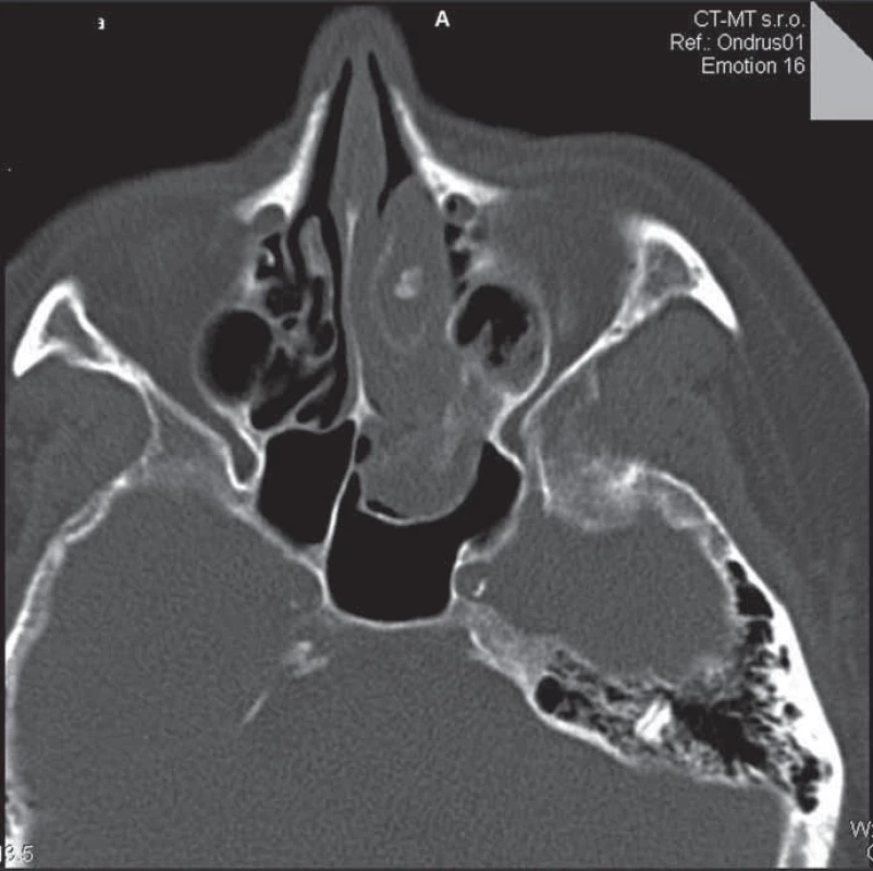 CT vyšetrenie prinosových dutín – axiálny rez.