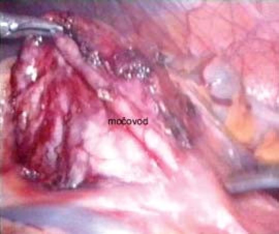 Obnažená pánvička a pyeloureterální přechod levé ledviny při transmezokolické pyeloplastice.