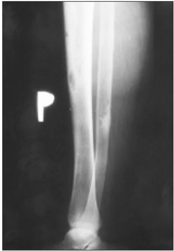 Osteolytická ložiska v dlouhých kostech dolní končetiny při terciární hyperparatyreóze.