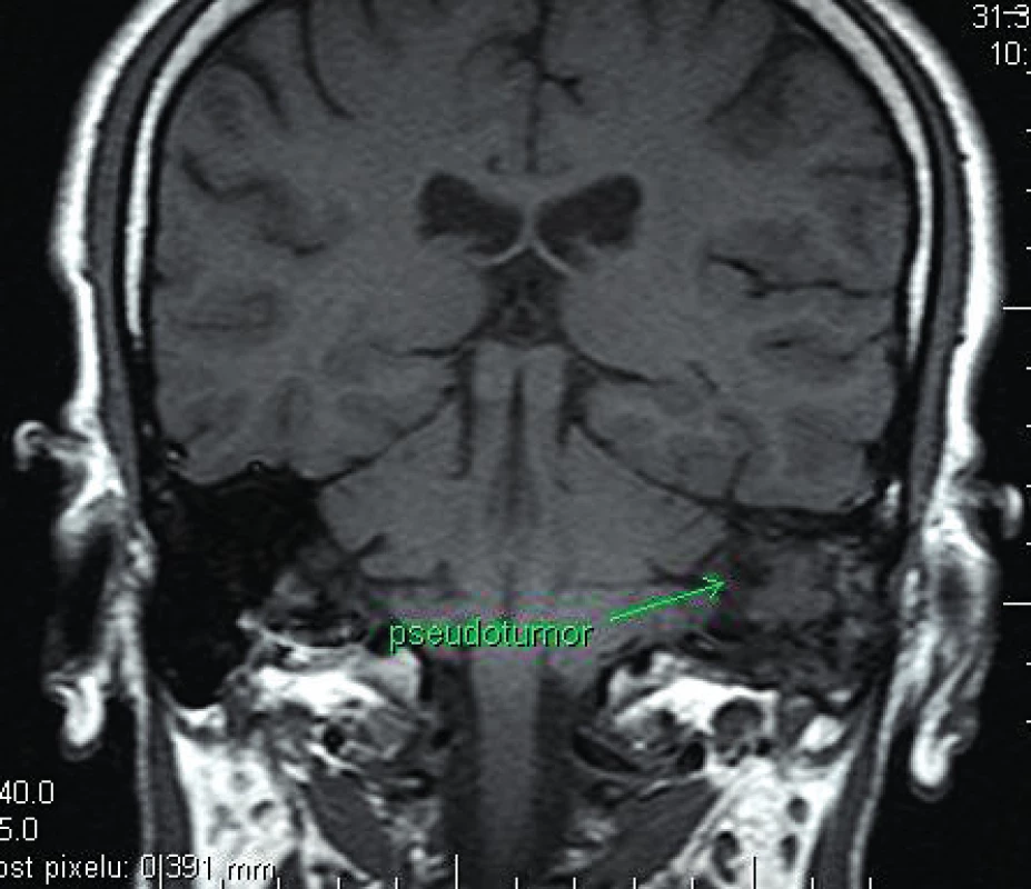 MRI koronární zobrazení pseudotumoru levé pyramidy (T1 sken s kontrastní látkou).