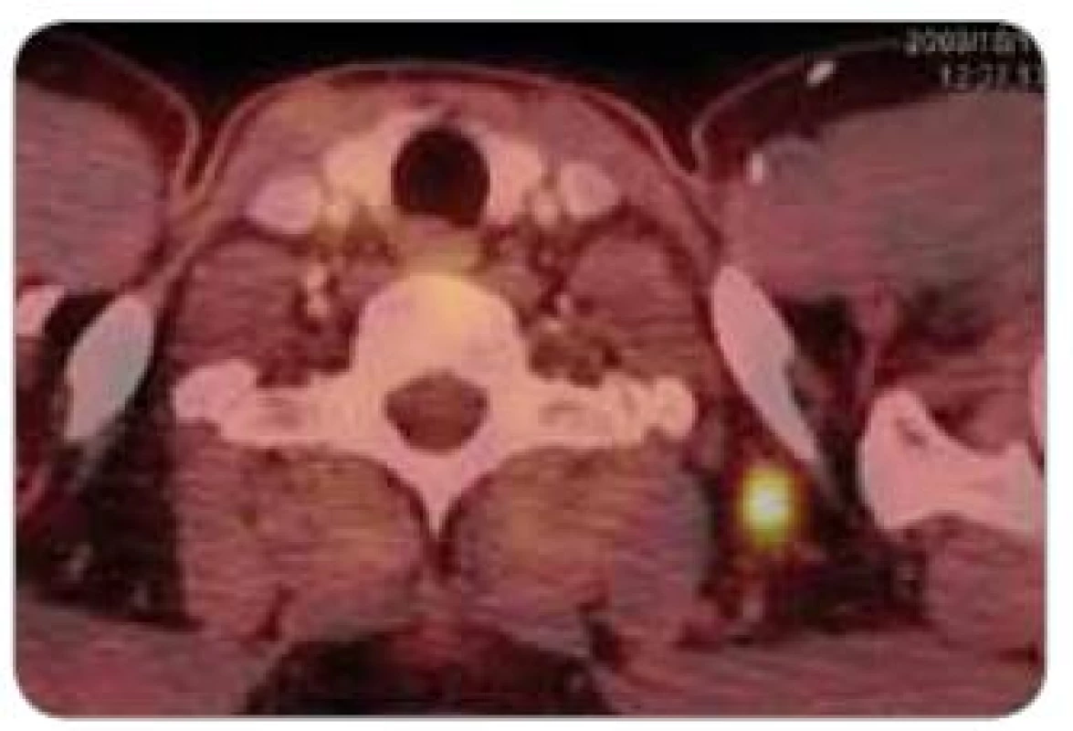 PET + CT – patologické ložisko infraklavikulárně vlevo.