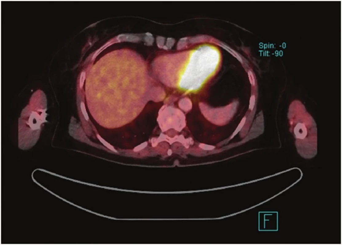 PET CT − Metastáza maligního melanomu v levém laloku jater
Fig. 2: PET CT − Metastasis of melanoma in the left liver lobe