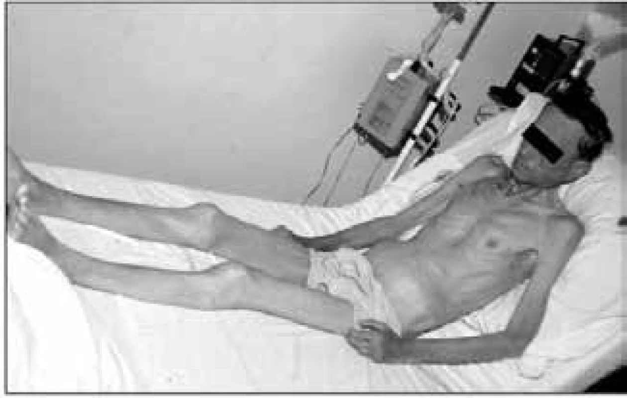 Vzhled nemocného s marantickým typem malnutrice a sarkopenií