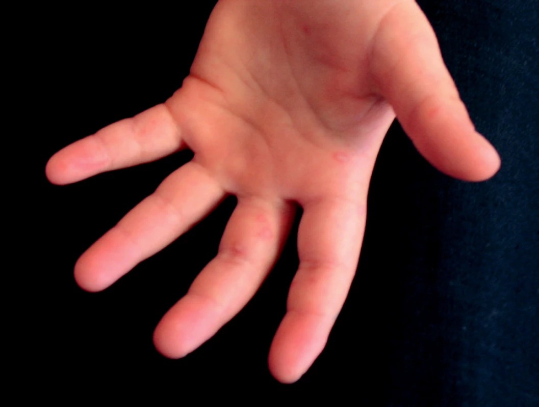 Hand, foot and mouth disease, 5-ročné dievča (enterovírusový exantém)