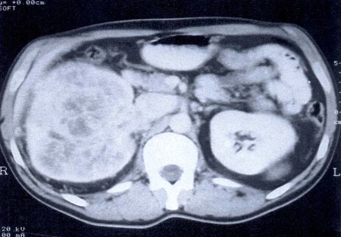 CT – tumor pravé ledviny s trombem v renální žíle a dolní duté žíle.