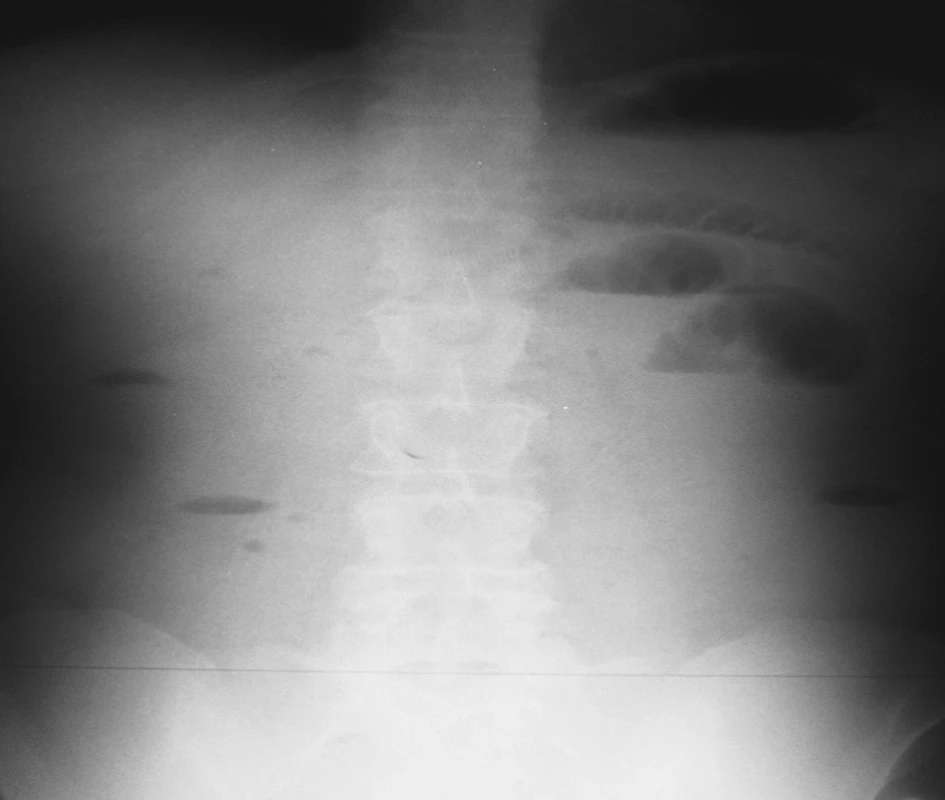 NSB postojačky – 16. 4. 2007 = kontrola na 2. deň hospitalizácie
Fig. 2. Upright native abdominal x-ray view – 16-04-2007 = a check-up on the 2nd hospitalization day