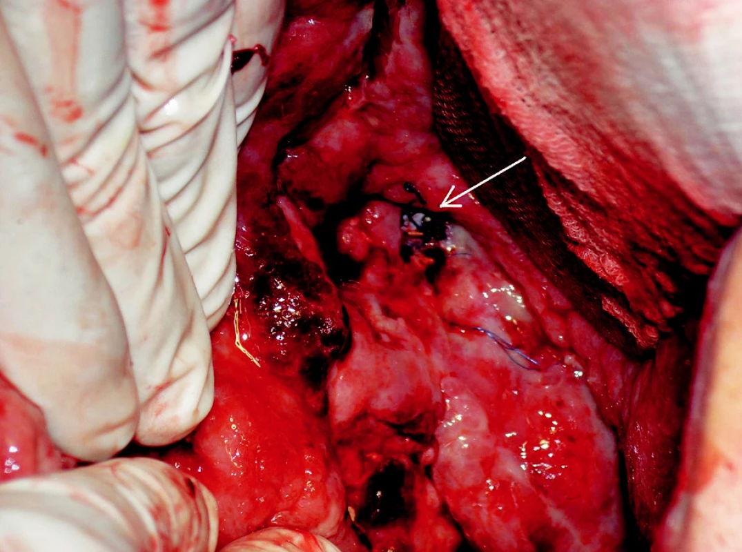 Snímek chirurgické revize. Na spodině dutiny je v defektu žilní stěny patrný stengraft (šipka)
Fig. 4. Surgical revision view. The introduced stent is visible through a venous wall defect (arrow)