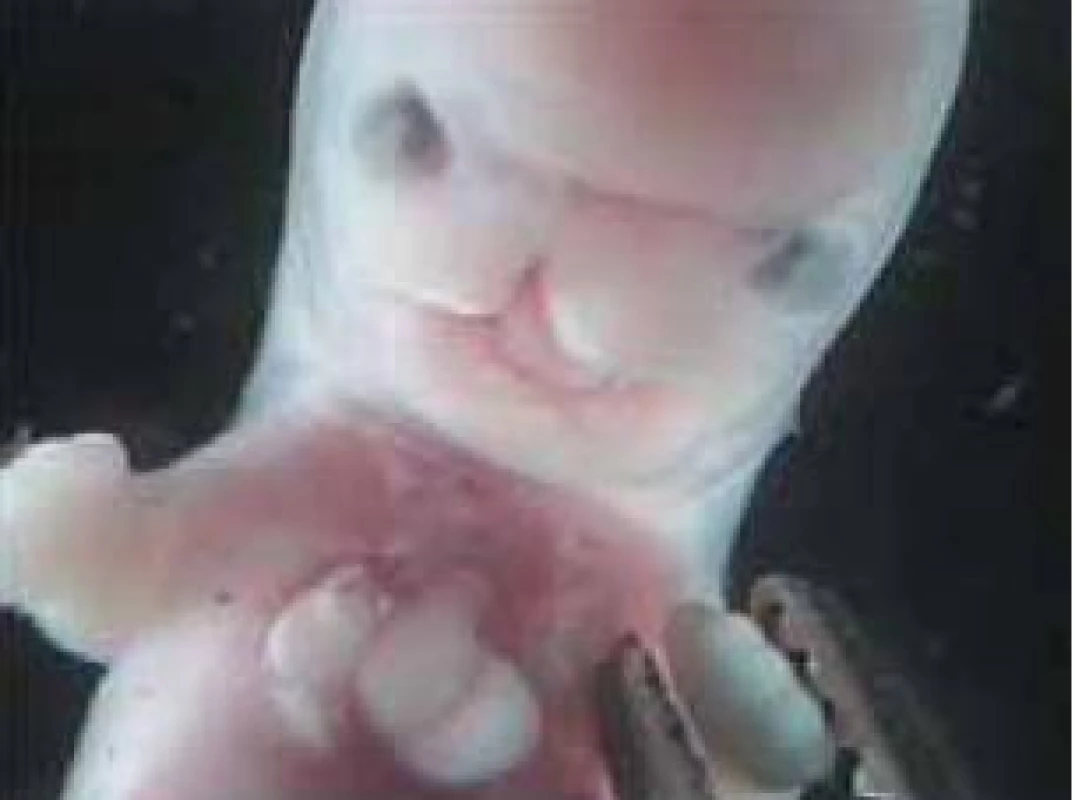 Rázštep pery (CL) na strane pravej u embrya v 40. dni vývoja, hodnotený ako missed ab. Vzhľadom na maceráciu tkanív sme nevedeli vylúčiť iatrogénny pôvod pozorovanej ektopie cordis. Išlo o parciálnu molu hydatidózu s karyotypom 69,XXX.