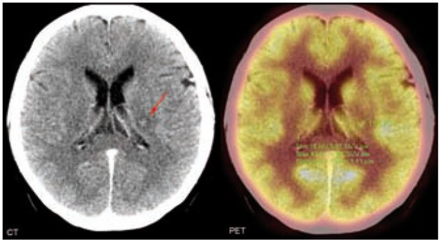 CT a PET mozku. Vlevo v oblasti talamu je patrné drobné ložisko smíšených denzit asi 1 cm v průměru (centrum izodenzní s jádry talamu, lehce hypodenzní okraj). Dále pak ani v zadní jámě, ani supratentoriálně neprokazujeme případné patologické ložiskové změny. Útvary střední čáry bez dislokace. Komorový systém není rozšířený. Ložisko mozku je na PET komponentě pro přítomnost fyziologicky vysoké aktivity pozadí nehodnotitelné.