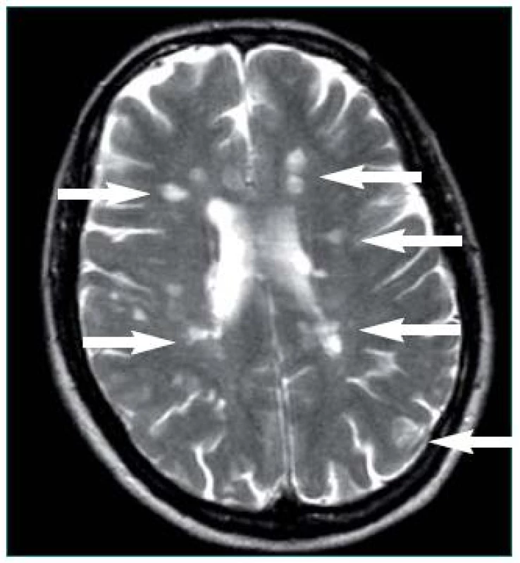 Šipky označují mnohočetná ložiska demyelinizace lokalizovaná periventrikulárně a v oblasti postranních komor mozku u pacientky s primárně progresivní formou RS.