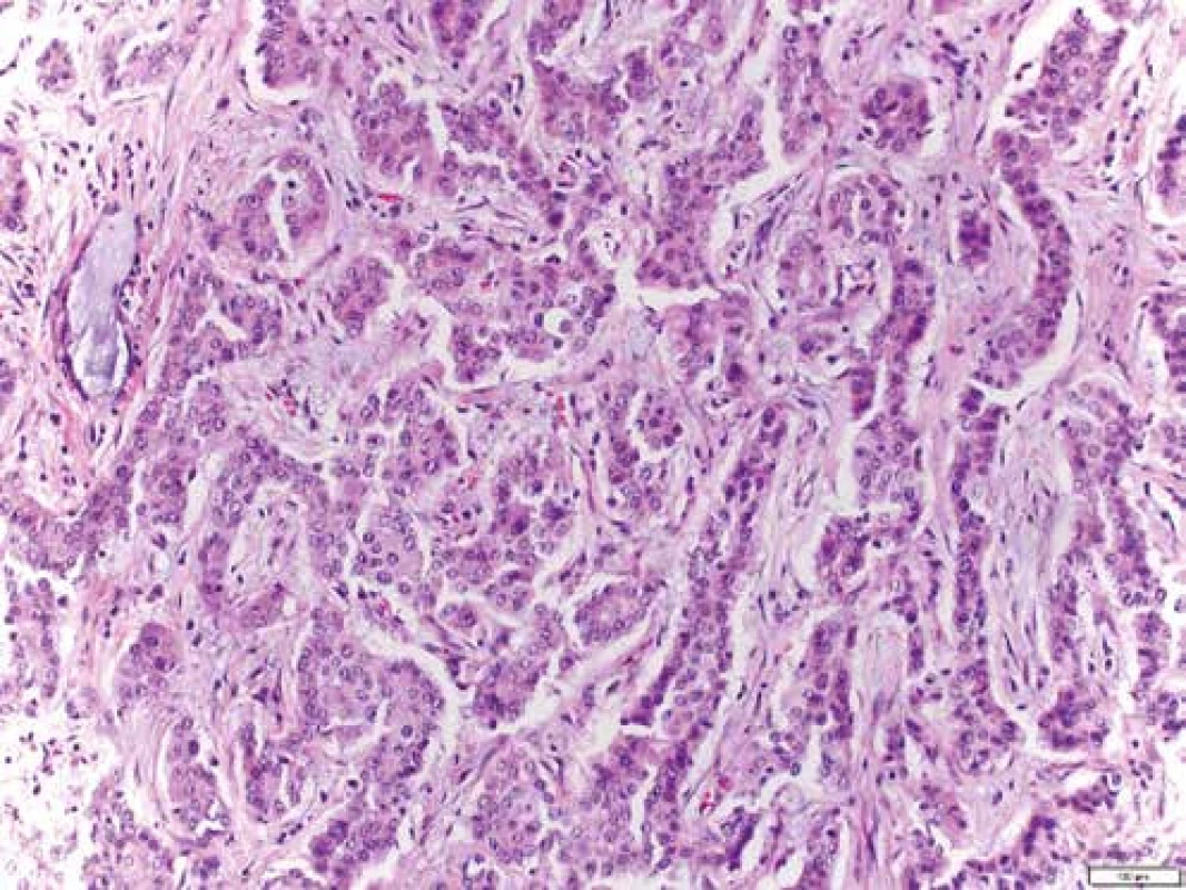 Histologie: hematoxylin-eozin (HE): trabekulárně uspořádané struktury maligního nádoru s desmoplastickou komponentou odpovídající obrazu cholangiocelulárního karcinomu