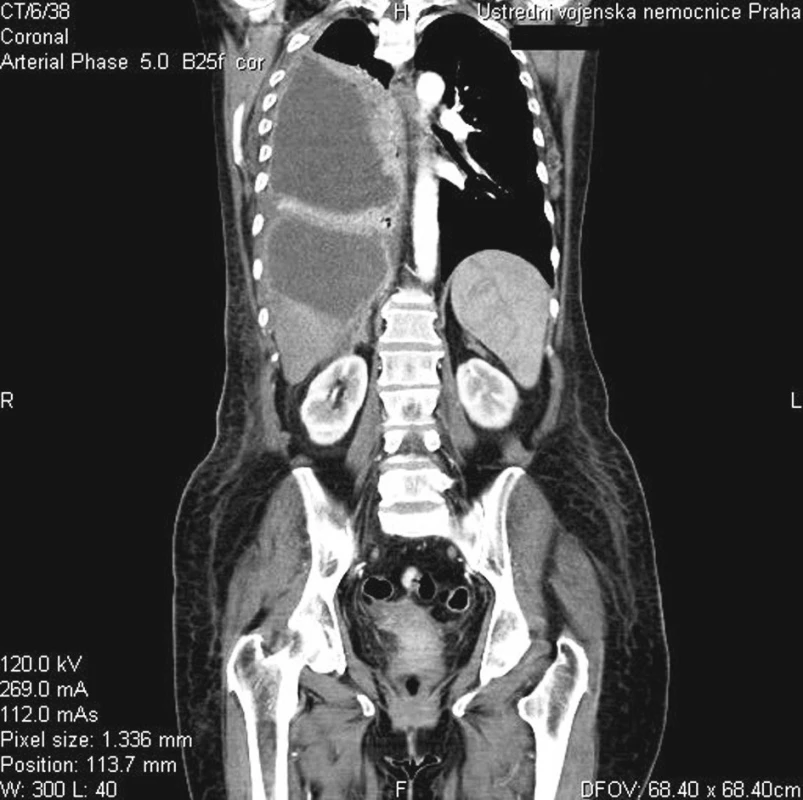 Tekutinové kolekce v okolí jater a v pohrudniční dutině (CT)
Fig. 2. Fluid collections around liver and within the pleural cavity (CT)