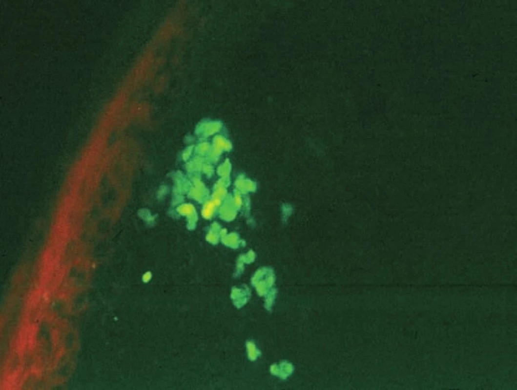 Hnízdo agregátů pod bazální membránou, typické pro lichen planus (přímá IF, IgM)