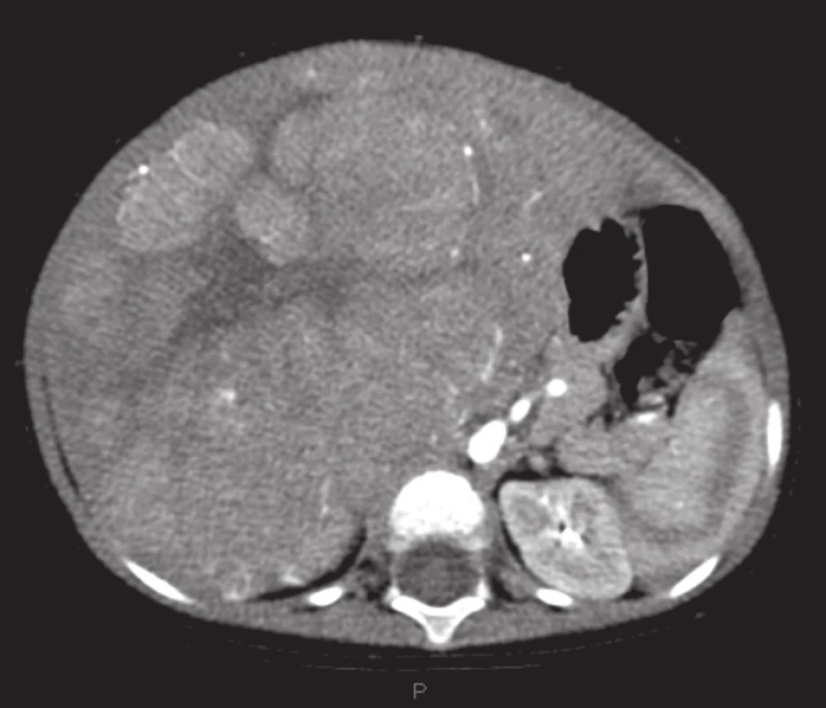 Obrovský hepatoblastóm pravého laloka pečene na CT, pacient č. 3
Fig. 1 Huge hepatoblastoma of liver right lobe on CT, patient No. 3