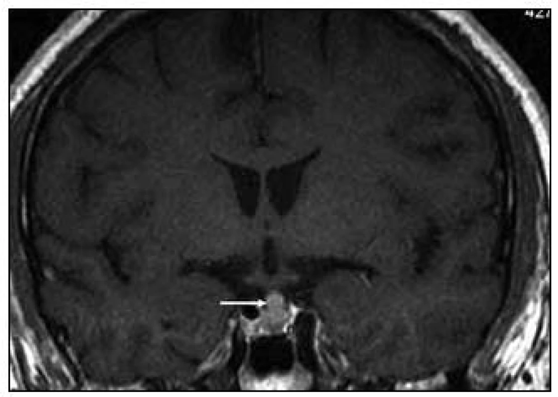 Koronární rovina MR zobrazení mozku před zahájením léčby, T1 vážený MR obraz po aplikaci k.l. Je
zřetelná ložisková sytící se infiltrace stopky hypofýzy.