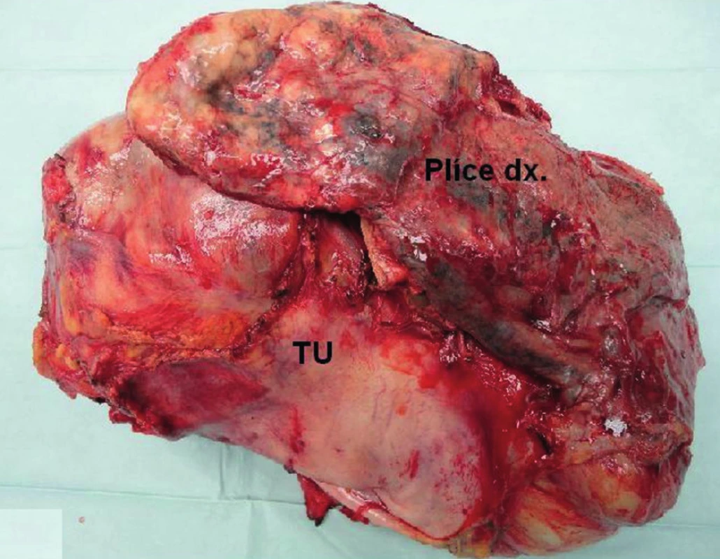 Resekovaný tumor, kazuistika 3
Fig. 5: Resected tumor, case report 3