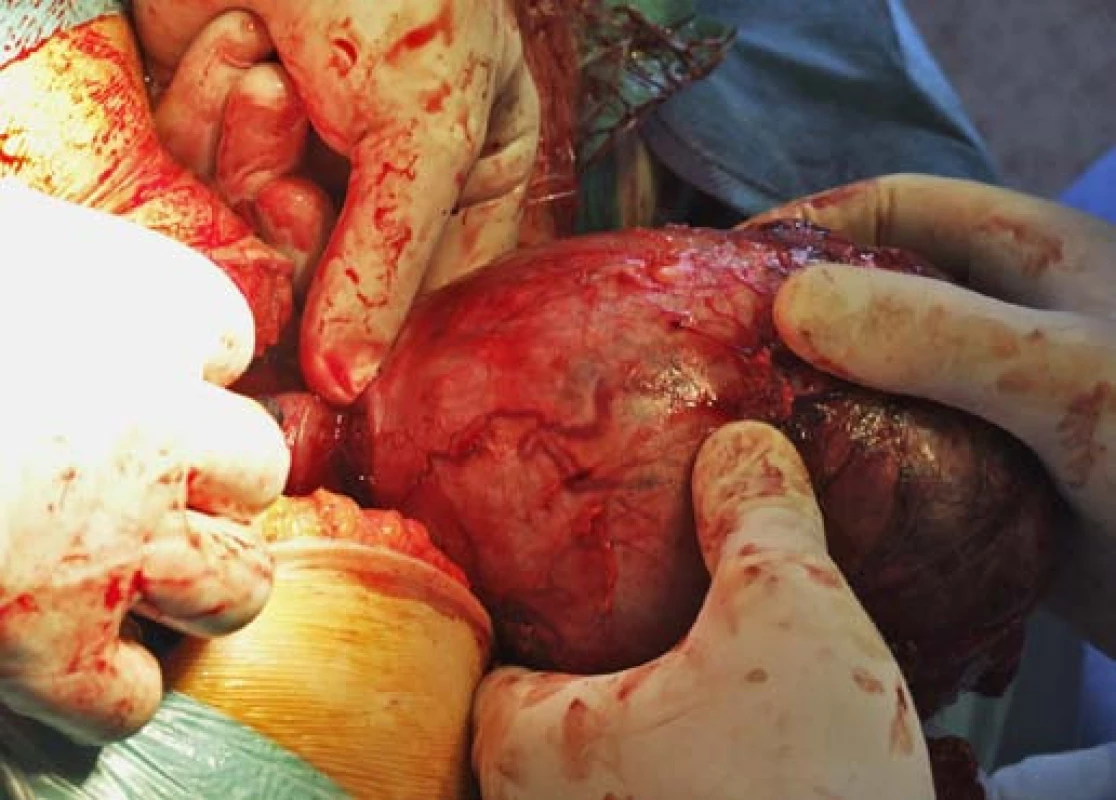 Úzké spojení ledviny s tumorem v oblasti dolního pólu pravé ledviny. Foto: 4× archiv autorů