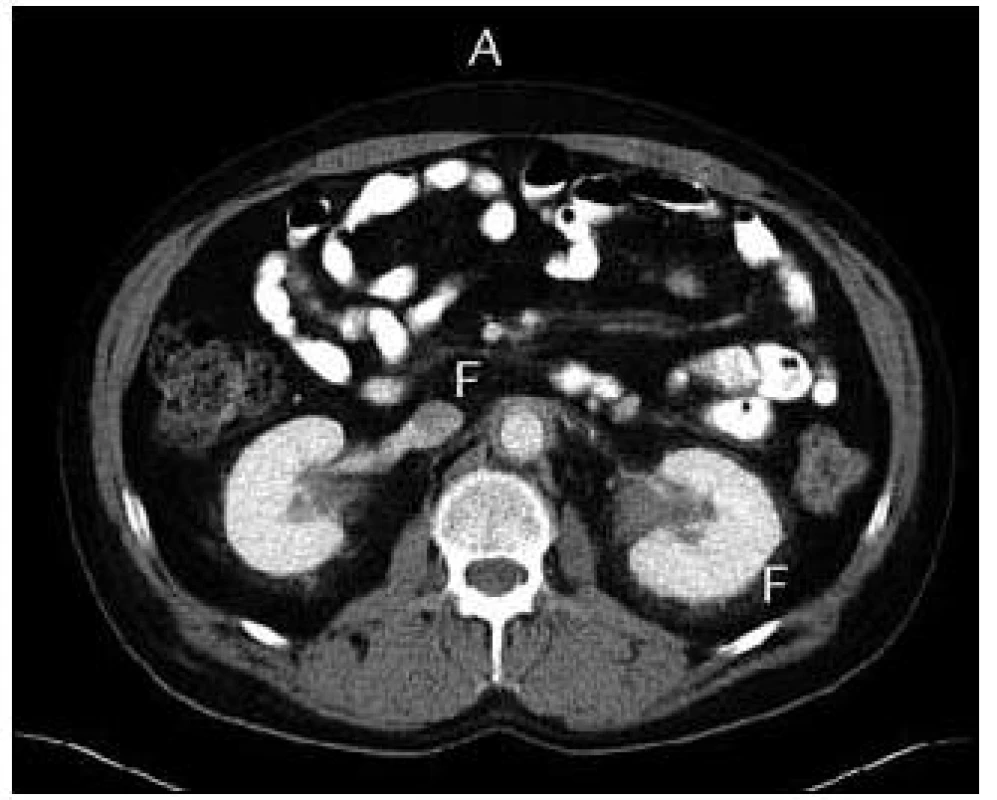 CT zobrazení dutiny břišní před léčbou Kineretem. Písmenkem F jsou označena místa s nejvýraznějšími fibrotickými změnami. Tyto fibrotické změny mohou komprimovat ureter a způsobit hydronefrózu.