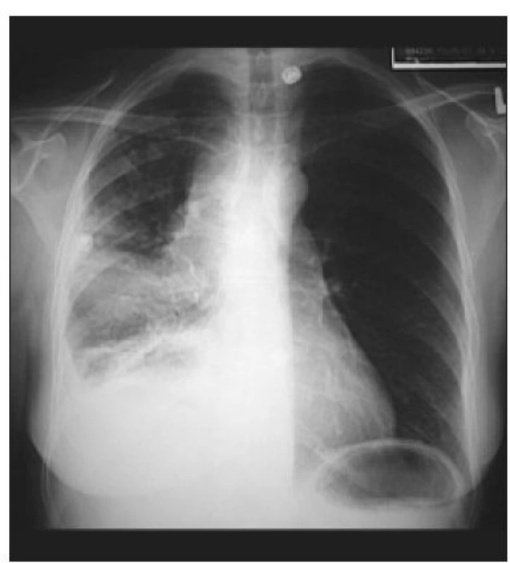 Skiagram hrudníku (zadopřední projekce) – tumor pravé plíce způsobující syndrom horní duté žíly.