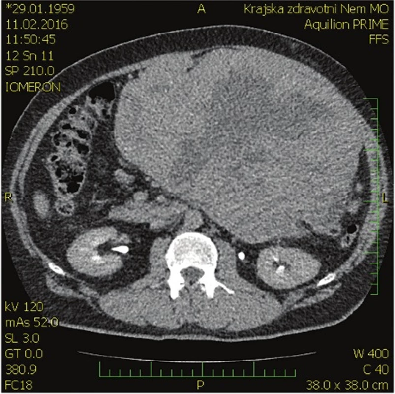 Předoperační CT břicha − axiální rovina
Fig. 1: Preoperative CT scan of the abdomen – axial plane