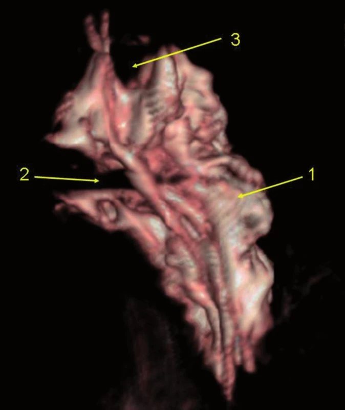 Infraklavikulární blok, 35 ml kontrastní látky
3D rekonstrukce CT vyšetření, laterální pohled na fascii brachiálního plexu, zářez zleva je způsoben existencí m. infraclavicularis, v horní části otisk arteria subclavia.
1 – 3D náplň infraklavikulárního prostoru (pohled z mediální strany)
2 – otisk m. infraclaviscularis
3 – otisk a. subclative