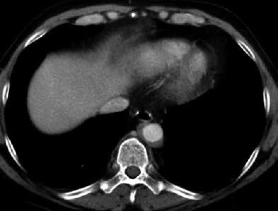 Postkontrastní CT vyšetření hrudníku, axiální rovina
Nepravidelně zesílená stěna sestupné hrudní aorty ve třech čtvrtinách jejího obvodu.