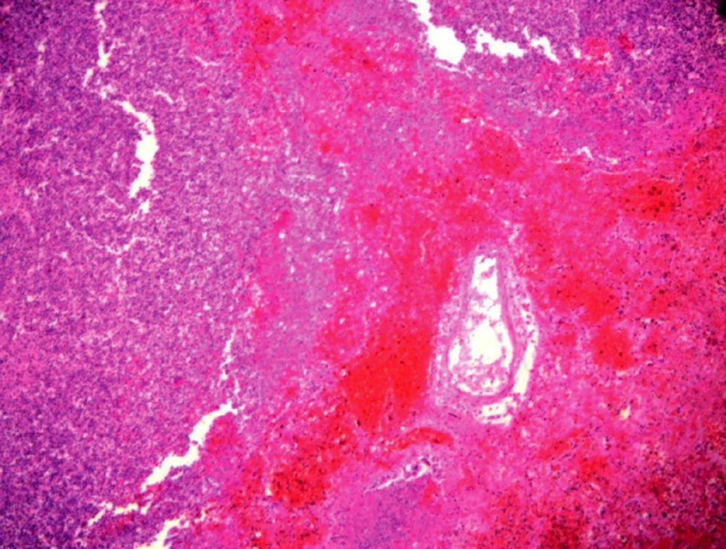 Detail části stěny akutního abscesu v plicích tvořeného hojnými polymorfonukleárními leukocyty a četnými kokovitými mikroorganizmy. Okolní tkáň je těžce překrvená až do obrazu apoplexie plicních sklípků.
Autor: MUDr. Monika Tůmová–Bartošková