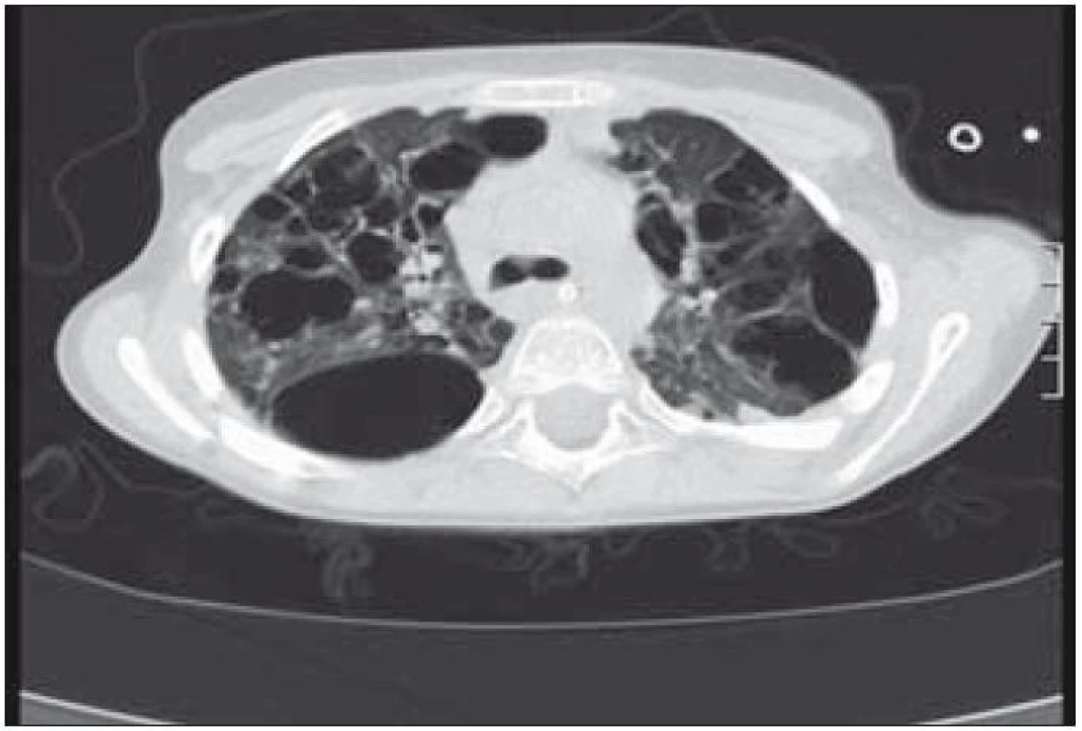 Mnohočetné bulózní změny v plicní tkáni (CT vyšetření).