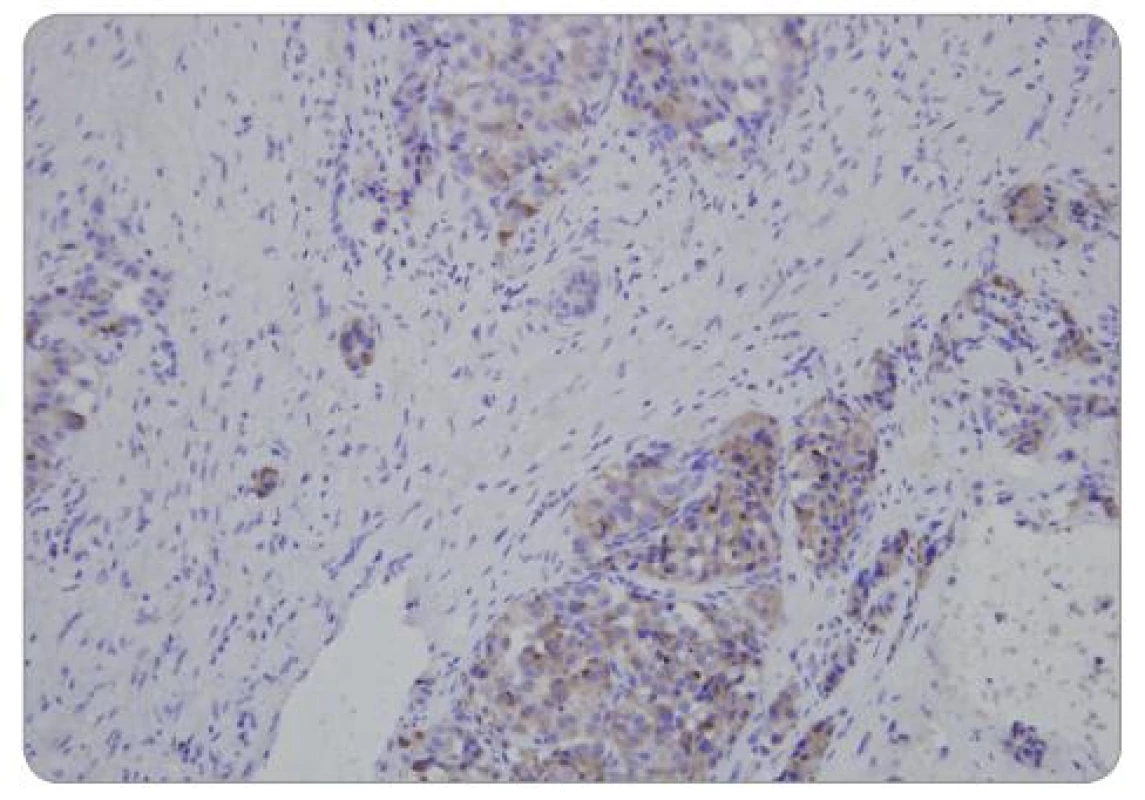 Neuroendokrinní nádor pankreatu – FNAB (chromogranin).