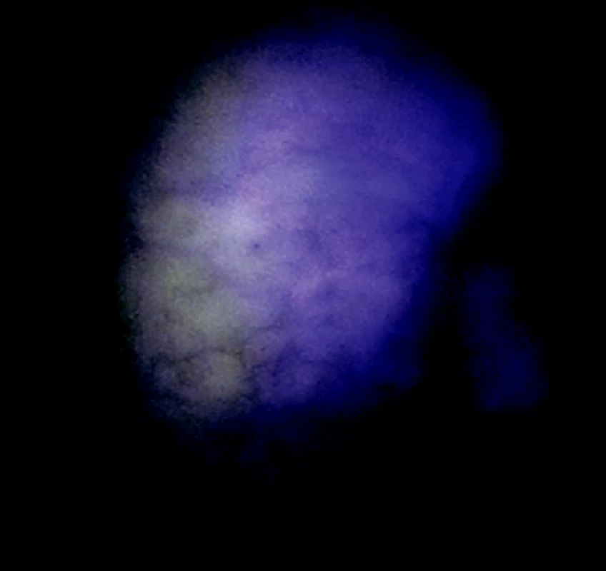 Okraje nádorovej infiltrácie v autofluorescenčnom obraze
Fig. 6. An autofluorescence view of the tumorous infiltration margins