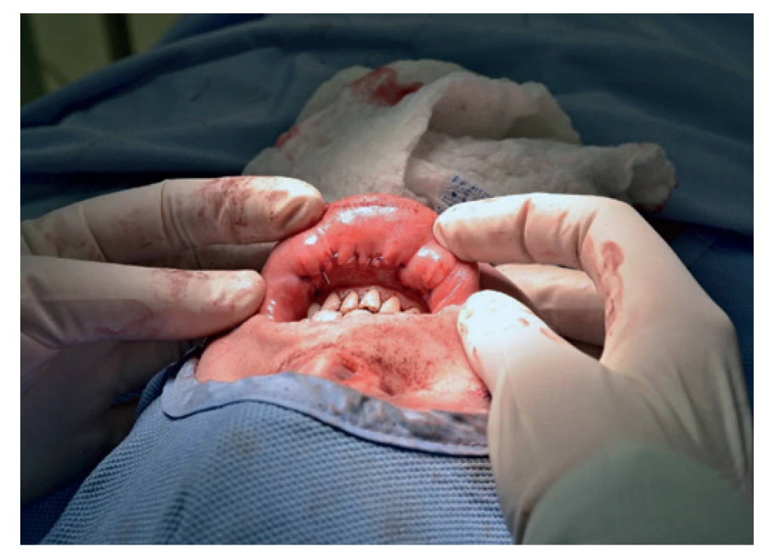 Sutura incizí ve vestibulu<br>
Fig. 5: Suture incisions in the vestibule
