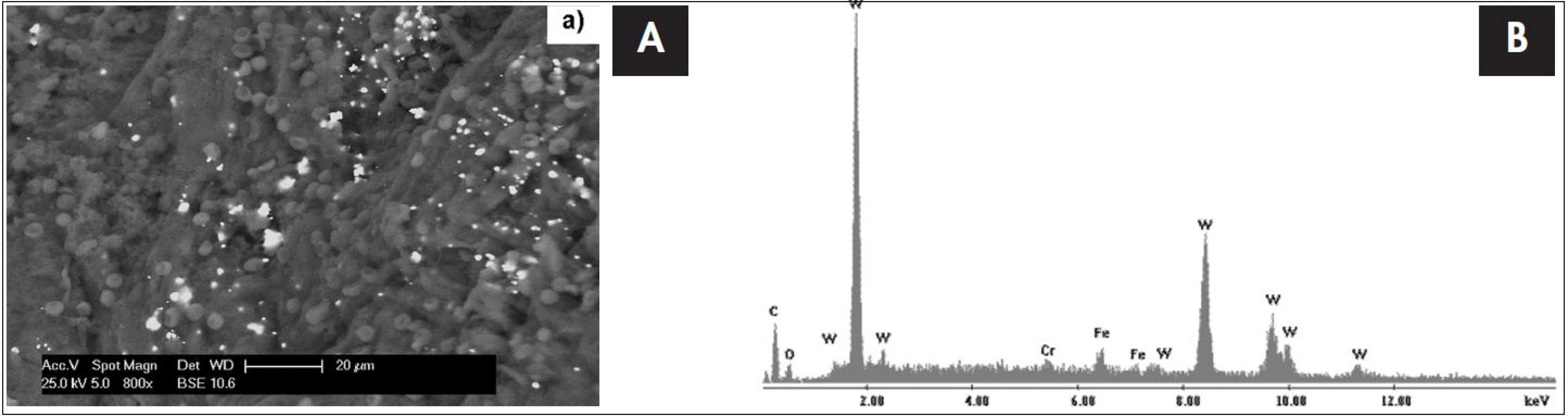 Snímek tkáně tonzily 4 letého dítěte s chronickou tonzilitidou ze skenovacího elektronového mikroskopu s EDS detektorem s odpovídajícím EDS spektrem, který je výsledkem bodové analýzy. Píky označené písmenem W dokazují přítomnost wolframu v tonsilární tkáni.