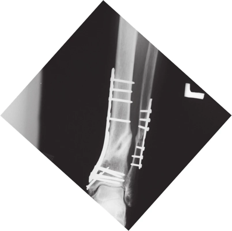Kontrolný rtg obrázok ľavého predkolenia – známky hojenia zlomeniny tíbie v 12. mesiaci po úraze
Fig. 10: Follow-up x-ray – healed left tibial fracture 12 months after the injury