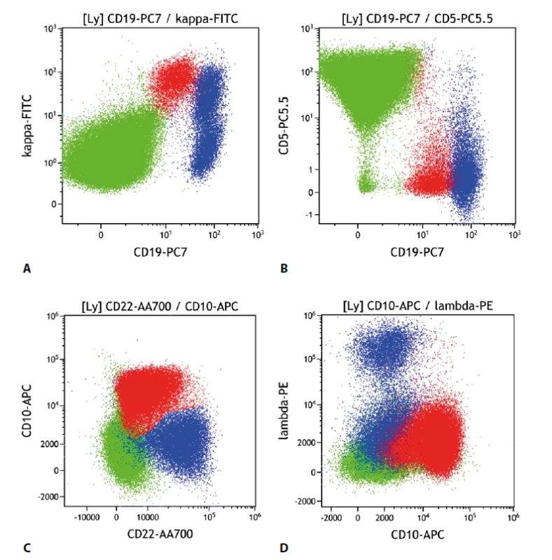 Folikulární lymfom. Průtoková cytometrie. Gate na lymfocyty. Buňky FL červeně, ostatní B lymfocyty modře, T lymfocyty a NK buňky zeleně. A - FL exprimuje slaběji CD19 oproti benigním B lymfocytům, je patrná monoklonální exprese povrchových lehkých imunoglobulinových řetězců kappa, B - FL se slabší expresí CD19 neexprimuje CD5, C - FL s pozitivní expresí CD10 a mírně sníženou expresí CD22, D - FL s pozitivní expresí CD10 a negativní expresí povrchových lehkých imunoglobulinových řetězců lambda (pozitivní je kappa řetězec).