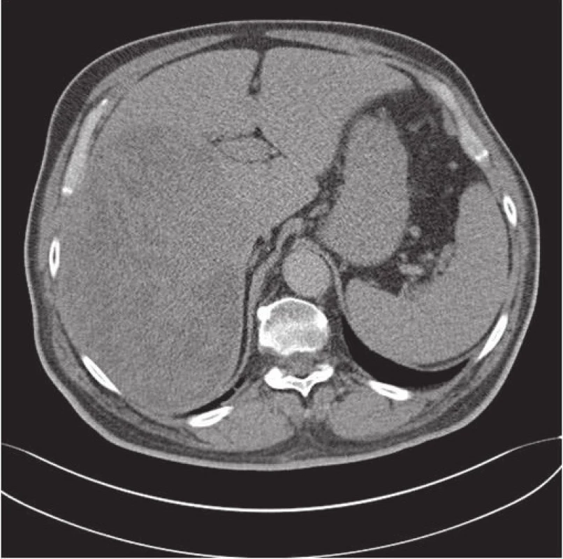 Vyšetřením CT se objevil velký tumor pravého laloku jater.