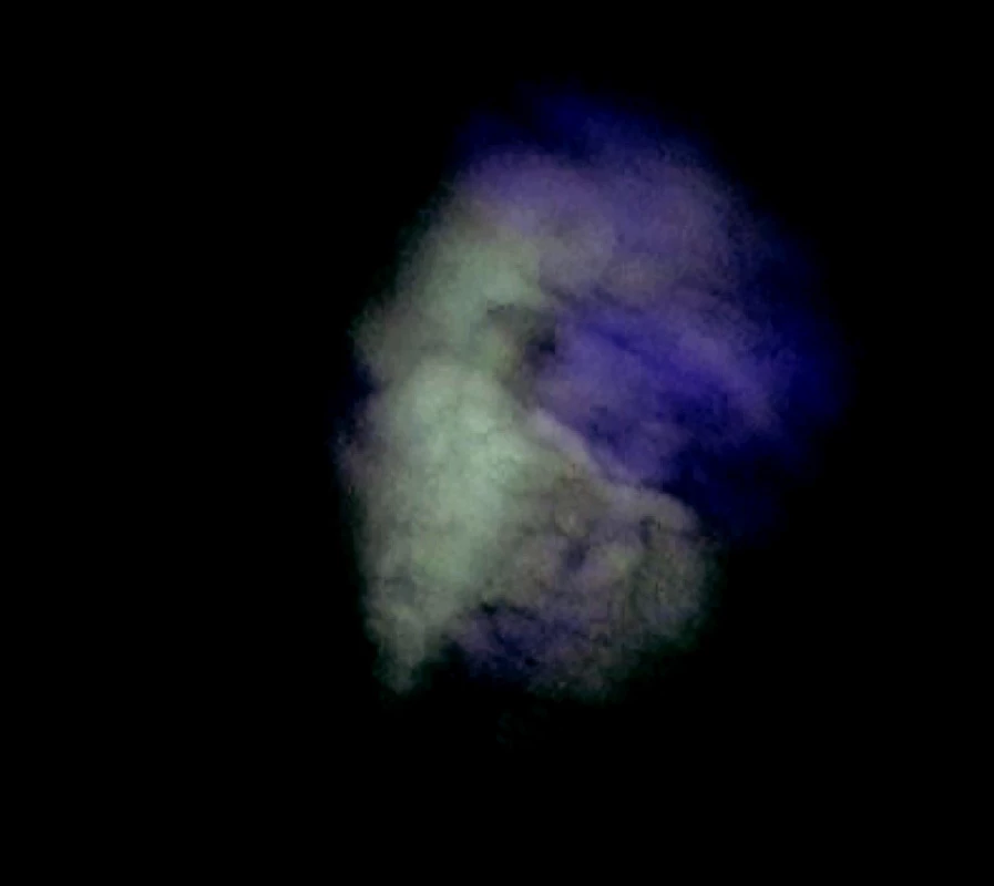 Pohľad na parietálnu pleuru bez postihnutia v autofluorescenčnom obraze
Fig. 2. An autofluorescence view of the unaffected parietal pleura