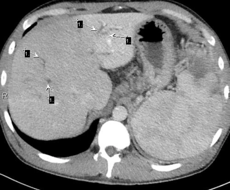 CT vyšetření – mírná intrahepatická, biliární dilatace (1), nehomogenní slezina s infarktem