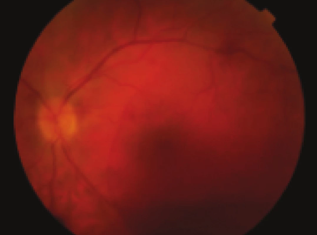 Pac. č. 1 – farebná fotografia očného pozadia v deň prijatia pred operáciou, krvácania sú lokalizované v dutine sklovca, pod zadným kortexom sklovca a pod MLI