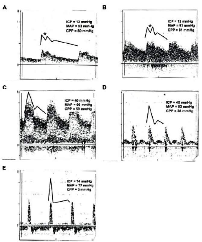 Grafické znázornění vývoje průtokového vzorce na křivce pulzního dopplera v průběhu nárůstu ICP (obrázek A-E)