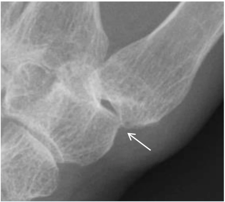Rentgenový snímek osteoartrózy karpometakarpálního kloubu palce (rizartróza). Šipka ukazuje na osteofyt, přítomné obvykle bývají zúžení kloubní štěrbiny, sklerotizace a cysty.