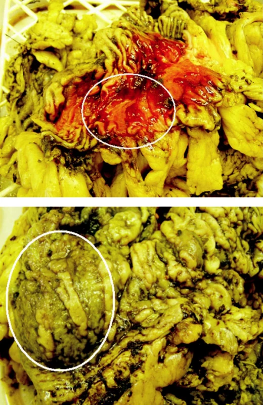 Myotické ložisko v resekátu střeva
Fig. 5. Myotic focus in the colon resecate
