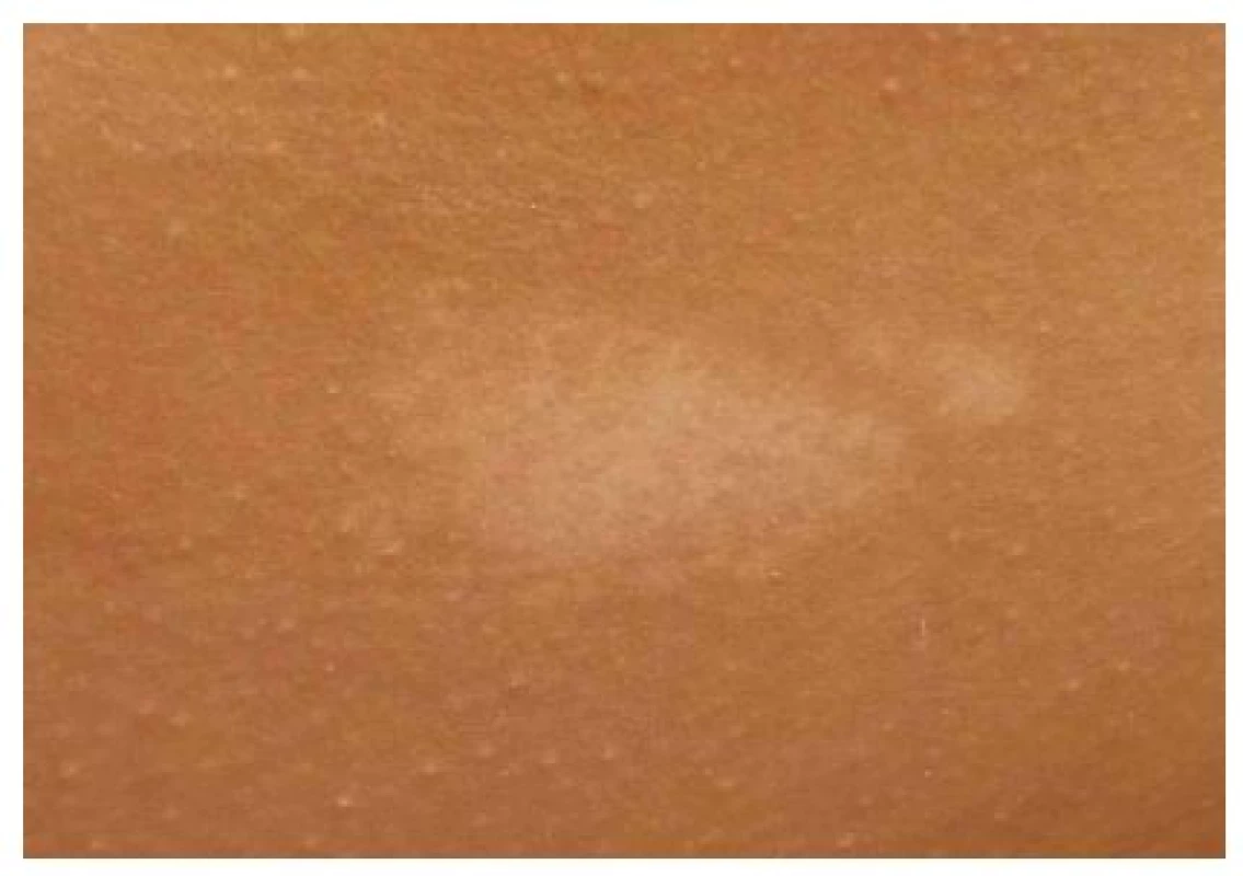 Hypomelanotická makula na kůži trupu